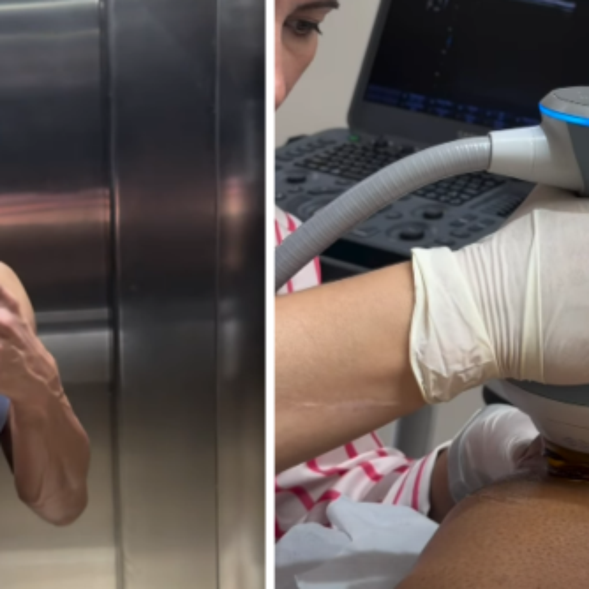 Gracyanne Barbosa recorre a punção para retirar líquido do joelho devido à 'Dança dos Famosos'
